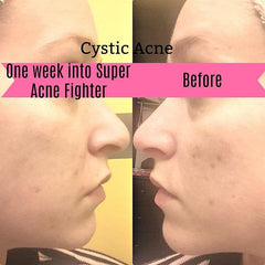 Organic Acne Treatment